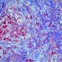 Cytoplasmic inclusions in glycogen storage disease type 4 (GSD4)