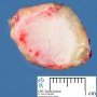Nodular melanoma of the scalp