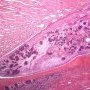 Caliceal invasion by a Wilms tumor