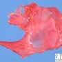 Left diaphragmatic hernia (fetus, 25 weeks)