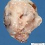 Fetal hydronephrosis with polar cystic dilatation