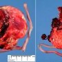 Long umbilical cord (39 cm for normal at 17 cm at 19 weeks)
