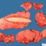 Mature lipoma