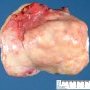 Ovarian fibrothecoma