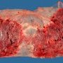 Bilobar placenta with duplex insertion of the umbilical cord