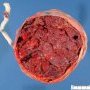 Normal placenta (28 weeks)