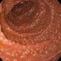 Duodenal nodular lymphoid hyperplasia
