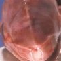 Pfeiffer syndrome