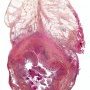 Acute appendicitis