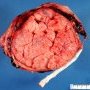 Placenta (Fetus, 17 weeks)