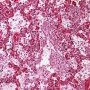 Acute pneumonia in bacterial pneumonia