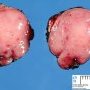 Pancreatic insulinoma