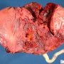 Placenta percreta