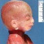 Macrocephaly by hydrocephaly (fetus, 21 weeks)