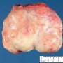 Ovarian fibrothecoma