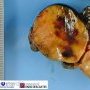 Chromophobe renal cell carcinoma