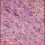 Epithelioid sarcoma