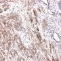 Plexiform fibrohistiocytic tumor