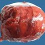 Ruptured WIlms tumor