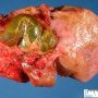 Kasai procedure in extra-hepatic biliary tract atresia