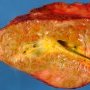 Dilatation of main bile ducts in extrahepatic biliary tract (...)