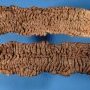Colectomy of ulcerative colitis