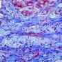 Carbohydrate-laden macrophages in GSD4