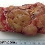Thymoma, type A