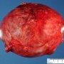 Cystic partially differentiated nephroblastoma