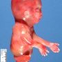 Caudal regression syndrome with lombosacral agenesis