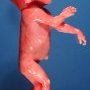 Hydrocephaly in a 21 weeks fetus