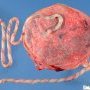 Long umbilical cord (104 cm at 34 weeks)