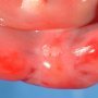 Genital hypoplasia in caudal regression sequence (case 10783)