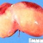 Liver ischemia in neonatal shock with DIVC