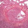 Invasive pulmonary aspergillosis