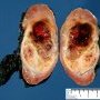 Post-chemotherapy Wilms tumor