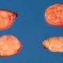 Nodal Castleman disease