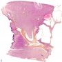 Cystic nephroma