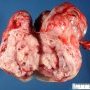Intra-abdominal immature teratoma