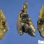 Cystic dilatation of bile ducts in extrahepatic biliary tract (...)