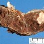 Placental intervillous thrombus