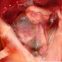 Renal adysplasia (renal agenesis and renal dysplasia)