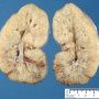 ARPKD kidney in a neonate (1 month)