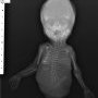 Caudal dysplasia with limb agenesis