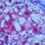 Polyglycosan inclusions in glycogen storage disease type 4 (GSD4)