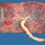 Bilobar placenta with duplex insertion of the umbilical cord