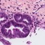 Biliary epithelial dysplasia in choledochal cyst
