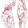 subpleural bulla in Marfan disease