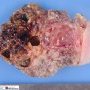 Hypodermal cystic lymphangioma