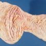 Borderline serous ovarian cystadenoma